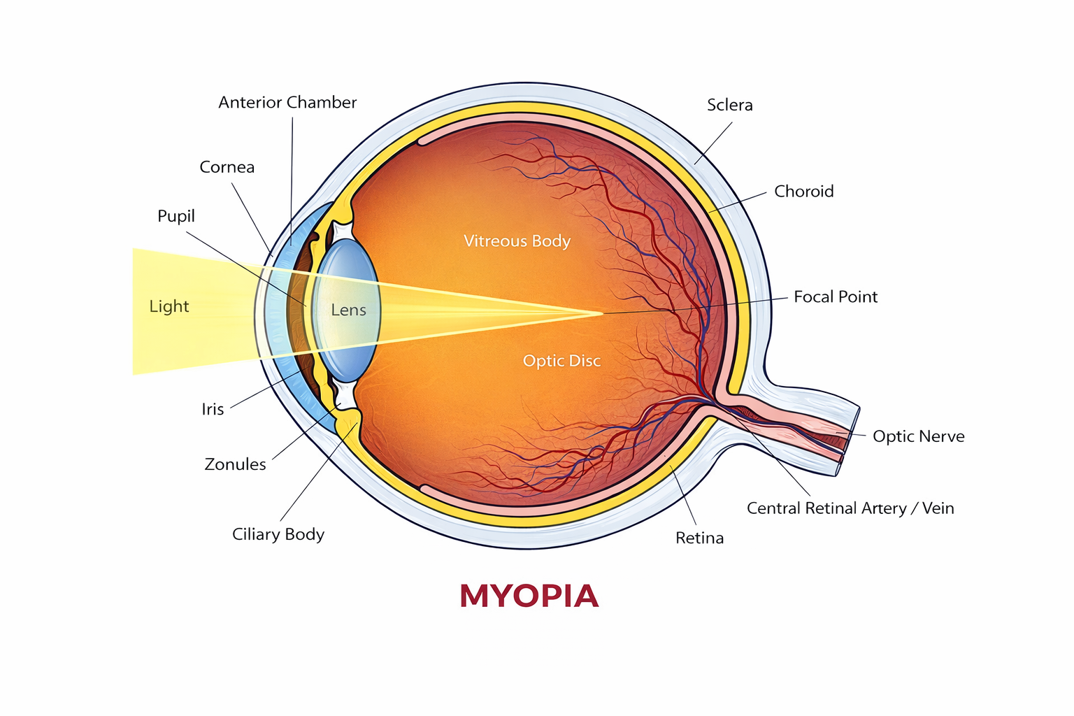 Myopia Management