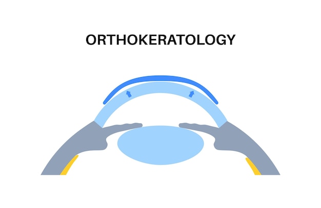 Orthokeratology